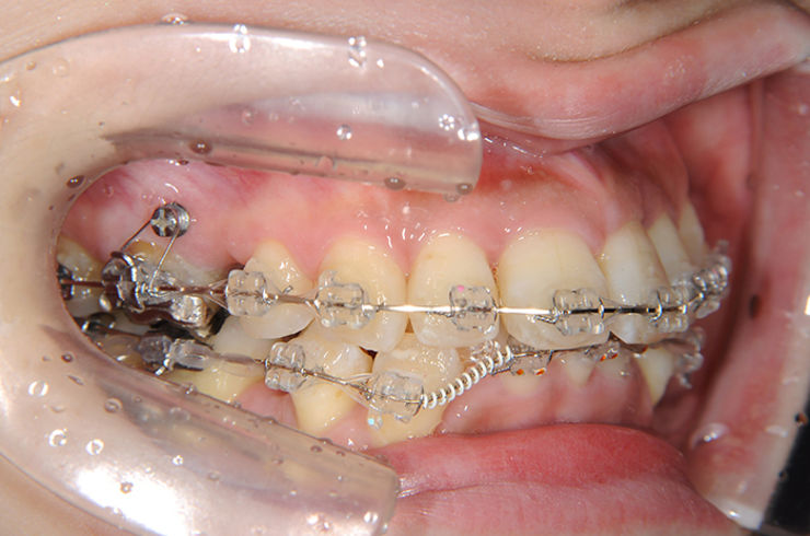 歯科矯正用アンカースクリュー（デュアル・トップオートスクリュー）