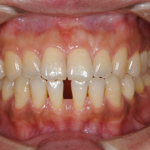 巣鴨や池袋、文京区や板橋区近隣で部分矯正をするなら大塚たまみ矯正歯科へ