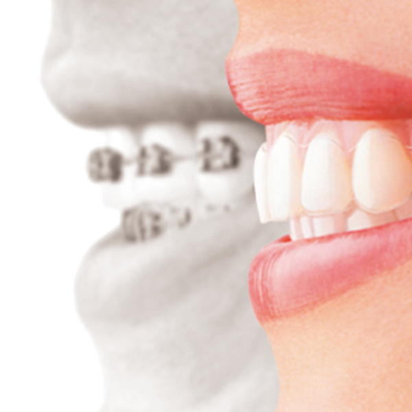 巣鴨や池袋、文京区や板橋区付近で下顎の反時計周りオートローテーションを行う矯正歯科をお探しなら当院へ