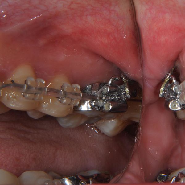 巣鴨や池袋、文京区や板橋区近隣で歯科矯正用アンカースクリュー（デュアル・トップオートスクリュー）を利用する矯正治療を行う大塚駅の大塚たまみ矯正歯科