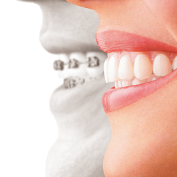 巣鴨や池袋、文京区や板橋区近隣でスピーディーな矯正歯科をお探しの方へ